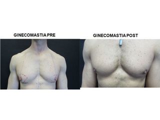 Ginecomastia prima e dopo