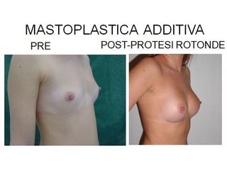 Mastoplastica additiva prima e dopo