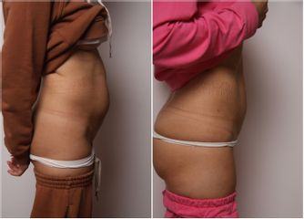 Liposuzione - Dott.ssa Silvia Scevola