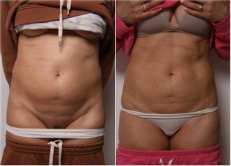 Liposuzione - Dott.ssa Silvia Scevola