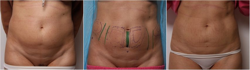 Liposuzione - Dott.ssa Silvia Scevola