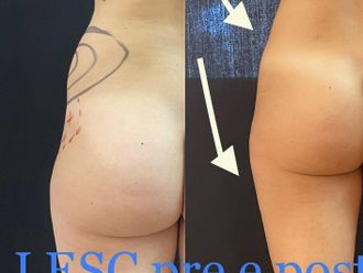 Cellulite prima e dopo - 872514