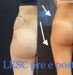 Dott.ssa Silvia Scevola Rimodellamento della silhouette con LESC