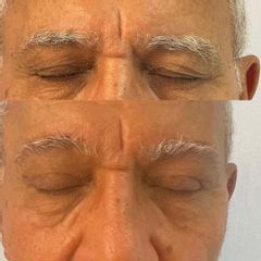 Dott.ssa Silvia Scevola blefaroplastica