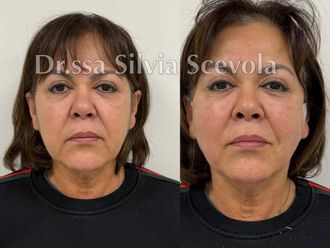 Fili riassorbibili prima e dopo - 877583