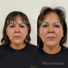 Dott.ssa Silvia Scevola Fili di trazione