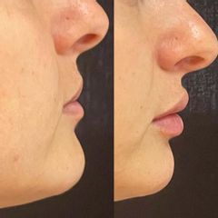 Dott.ssa Silvia Scevola Filler Labbra