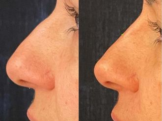 Rinofiller prima e dopo - 877586