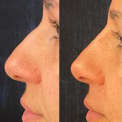 Dott.ssa Silvia Scevola Rinofiller