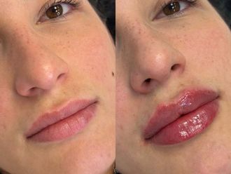 Filler labbra prima e dopo - 879684