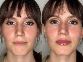 Filler labbra prima e dopo - 879685