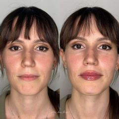 Dott.ssa Assmaà Abu-Higileh Filler Labbra