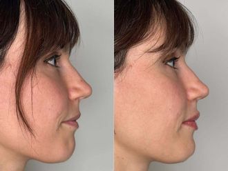 Filler labbra prima e dopo - 879686