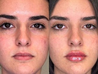 Filler labbra prima e dopo - 879687