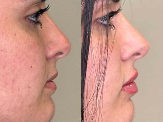 Filler labbra prima e dopo - 879688