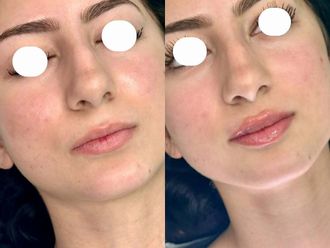 Filler labbra prima e dopo - 879689