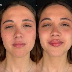 Dott.ssa Assmaà Abu-Higileh Filler Labbra