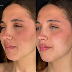 Dott.ssa Assmaà Abu-Higileh Filler Labbra
