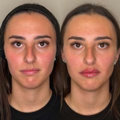 Filler labbra