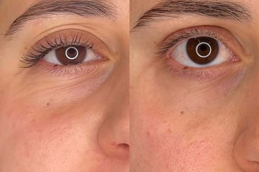Eliminare occhiaie prima e dopo - 879902