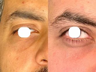 Eliminare occhiaie prima e dopo - 879903