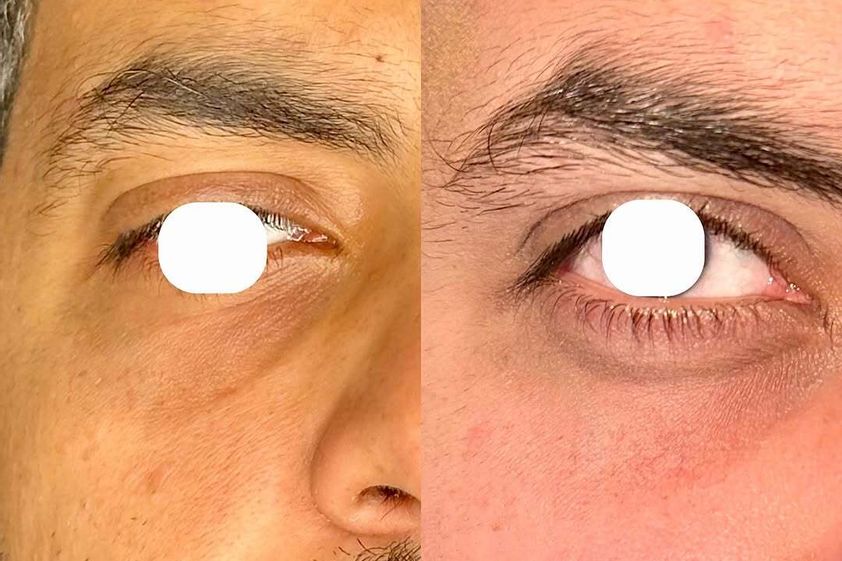 Eliminare occhiaie prima e dopo - 879903