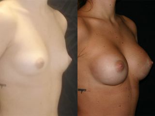 Mastoplastica additiva - Dott.ssa Paola Emiliozzi