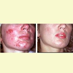 acne prima dopo