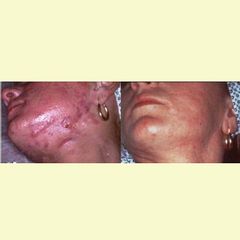 acne prima dopo