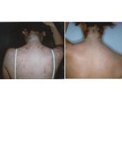 acne prima dopo