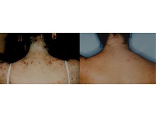 Acne prima dopo