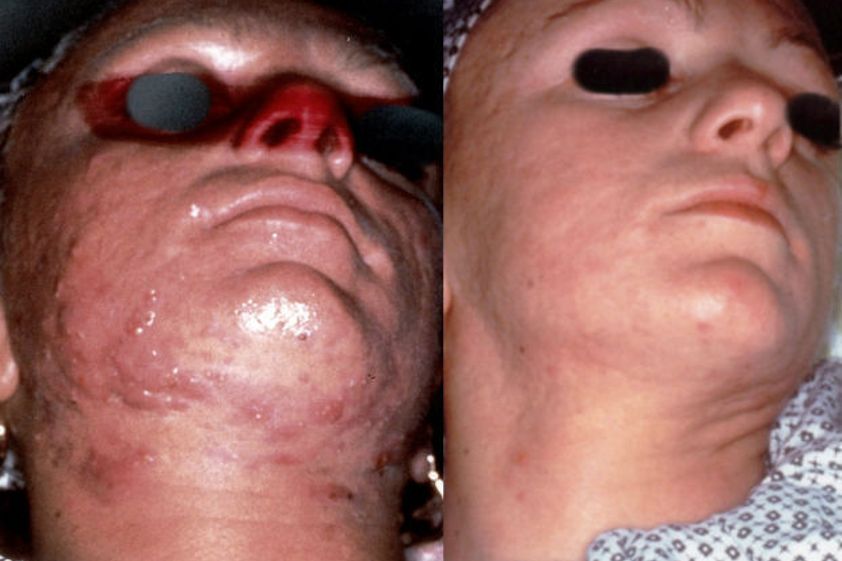 Acne prima e dopo - 760805