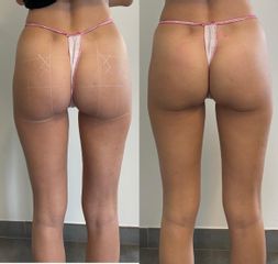 Riempimento glutei con Filler corpo - Dott. Antonio Licata