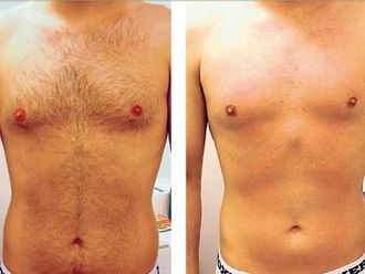 Depilazione a Luce Pulsata prima e dopo - 750409