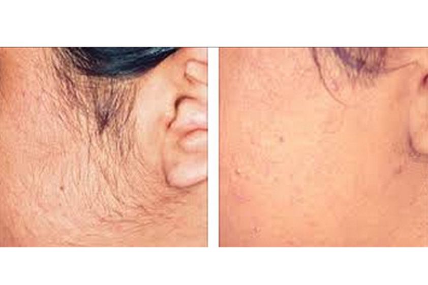 Depilazione laser prima e dopo - 752064