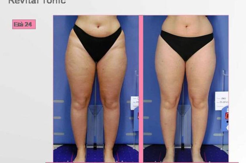 Velashape prima e dopo - 762330