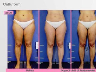 Velashape prima e dopo