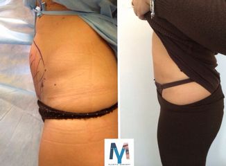 Mini Liposuzione prima dopo