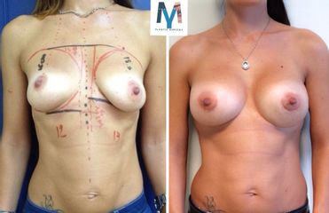 mastoplastica additiva prima dopo
