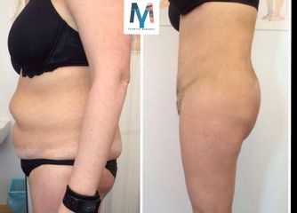 lipoaddominoplastica prima dopo