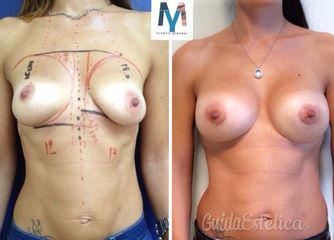 mastoplastica additiva prima dopo
