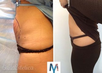 Mini Liposuzione prima dopo
