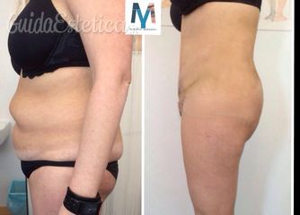 Lipo addominoplastica prima dopo