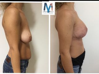 Mastopessi con protesi prima dopo