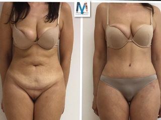 lipoaddominoplastica prima dopo