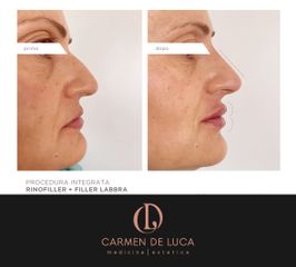 Filler labbra - Carmen De Luca Chirurgia e Medicina Estetica