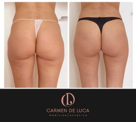 Cellulite - Carmen De Luca Chirurgia e Medicina Estetica