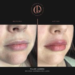 Filler labbra - Carmen De Luca Chirurgia e Medicina Estetica