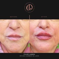 Filler labbra - Carmen De Luca Chirurgia e Medicina Estetica