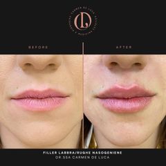 Filler labbra - Carmen De Luca Chirurgia e Medicina Estetica